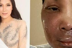 Hương Tràm, Dương Triệu Vũ và đồng nghiệp xót xa khi nhìn thấy gương mặt bị bỏng chín của ca sĩ Hồng Ngọc