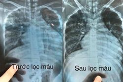 Bệnh viện Nội tiết Nghệ An cứu sống bệnh nhân đái tháo đường có biến chứng nặng