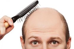 Những thói quen gây rụng tóc dễ mắc phải