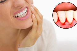 Chảy máu chân răng: Nguyên nhân và cách khắc phục