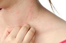 Sẩn ngứa do gan và cách ứng phó
