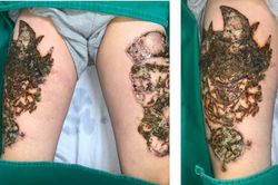 Bị nhiễm trùng nặng cả 2 đùi vì xóa xăm theo lời quảng cáo trên mạng