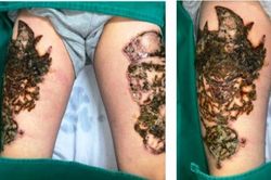 Hà Nội: Biến chứng rợn người khi xóa xăm tại spa