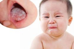 Giải đáp thắc mắc về bệnh tưa lưỡi ở trẻ sơ sinh