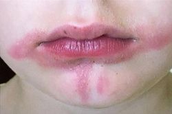 Cậu bé bỏng khắp miệng sau khi ăn kem chanh, nguyên nhân khiến gia đình bất ngờ
