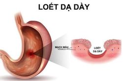 Viêm loét dạ dày do tự ý dùng thuốc giảm đau