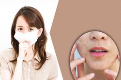 Xử lý trục trặc ở da do đeo khẩu trang kéo dài