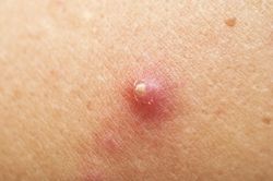 Cảnh báo về biến chứng rất nguy hiểm của bệnh 'hậu bối'