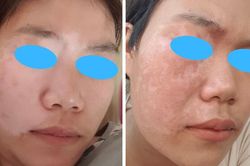 Lần đầu tiên ghép tế bào tự thân chữa lành cho bệnh nhân bạch biến
