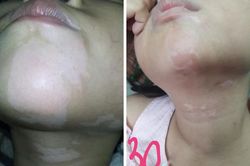 Phương pháp mới ghép tế bào tự thân chữa bạch biến ở Việt Nam