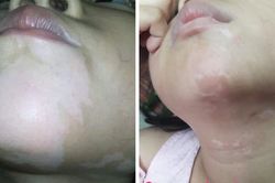 Lần đầu tiên ghép tế bào thượng bì tự thân để trị bệnh bạch biến