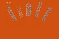 Australia tạo đột phá trong sản xuất stent nhờ công nghệ in 3D