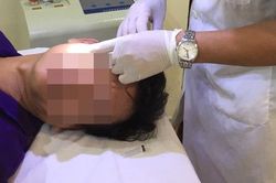 Kinh dị thiếu nữ 17 tuổi lở loét mặt vì lột trắng da, sai lầm nguy hiểm nhiều người đang làm đẹp ngày nắng