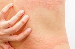 Mách bạn cách trị ngứa sâu róm hiệu quả nhất