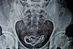 Bệnh nhân khai trót 'ăn' dây sạc điện thoại, nhưng bác sĩ lại tìm thấy trong bàng quang