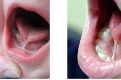 Không phải cứ trẻ chậm nói là mắc chứng tự kỷ