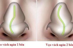 Biến chứng đáng ngại do vẹo vách ngăn mũi