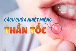Bị nhiệt miệng cứ thử 1 mẹo đơn giản, hết sưng đau nhanh bất ngờ