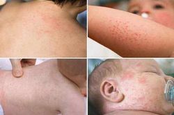 Xử trí trẻ bị ban nhiệt do nóng