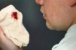 Ho khạc ra máu: Xử trí thế nào?