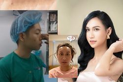 Sao Việt khoe ảnh phẫu thuật thẩm mỹ gây ám ảnh cho fan