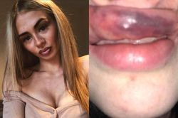 Môi bị sưng phồng, tụ máu vì tiêm filler kém chất lượng