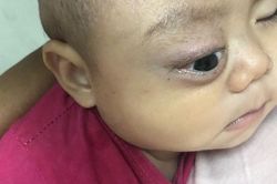 Xót thương bé trai dân tộc Nùng 7 tháng tuổi bị khối u đẩy lồi mắt ra ngoài