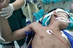 Cấp cứu thành công người bị thanh sắt đâm xuyên thấu từ nách lên vai