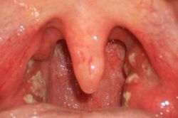 5 biện pháp cần thực hiện để phòng bệnh bạch hầu