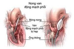 Bệnh hẹp động mạch phổi