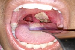 Liên tiếp 3 ổ dịch bạch hầu ở Đắk Nông: Cách nhận biết bệnh?
