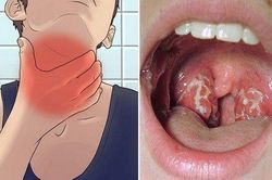 Các dấu hiệu tuyệt đối không thể bỏ qua của bệnh bạch hầu