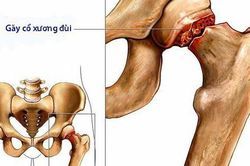 Giảm nguy cơ gãy xương nhờ dùng thuốc chống loãng xương sớm