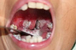 Kon Tum phát hiện 5 ổ dịch bạch hầu