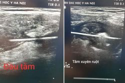 Hy hữu: Nuốt phải tăm... sau 2 tuần được lấy ra qua thành bụng
