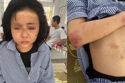 Cô gái bị kẻ cuồng yêu đánh dã man: Công bố kết luận giám định thương tích
