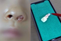 Ly kì chiếc răng 'mọc' trong xoang mũi bé gái 6 tuổi