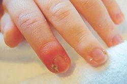 Chớ chủ quan với chín mé ngón tay