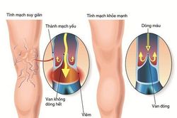 Chứng thoát thư trong Đông y
