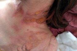 Lâm Đồng: Thực hư chuyện một phụ nữ bị người lạ tạt xăng đốt