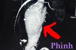 Cứu sống 3 bệnh nhân vỡ túi phình động mạch chủ bụng