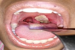 Bệnh bạch hầu nguy hiểm thế nào, dấu hiệu và cách phòng chống