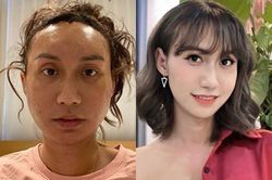 Lynk Lee, Lưu Đê Ly chia sẻ gì khi thừa nhận phẫu thuật thẩm mỹ?