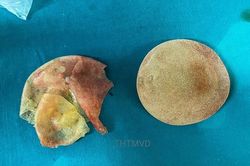 Bỏ khoản tiền lớn để nâng ngực, nữ trung niên nhập viện vì vỡ túi ngực mà không biết