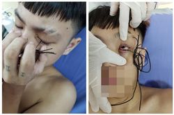 Lõi sợi dây điện đâm xuyên mi mắt chàng trai 16 tuổi