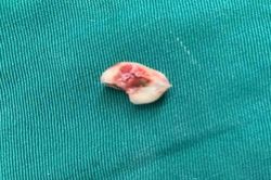 Đi nhổ răng sâu, bé gái bị răng rơi vào phế quản gây tắc đường thở
