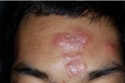 Bệnh phong xuất hiện ở Lạng Sơn