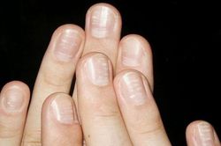 Thuốc nào trị vảy nến móng tay?