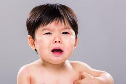 Những điều cha mẹ cần biết về dị ứng đạm sữa bò ở trẻ nhỏ