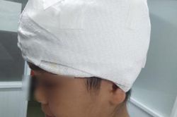 Máy cưa nước đá lột hơn một nửa da đầu của bé gái 11 tuổi